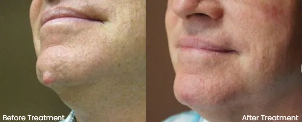 Cyst Treatment & Removal Options